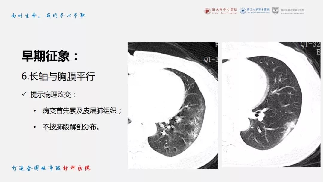 【PPT】新冠肺炎CT早期征象与临床基础及鉴别诊断