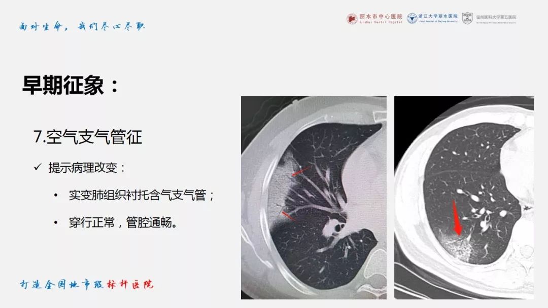 【PPT】新冠肺炎CT早期征象与临床基础及鉴别诊断