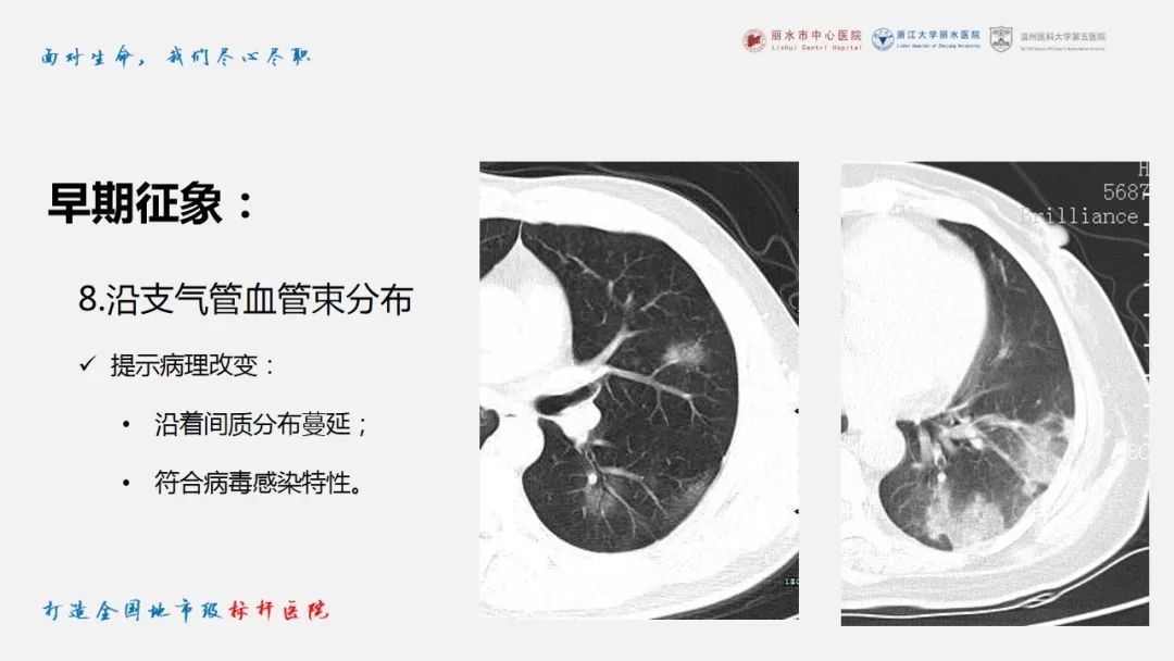 【PPT】新冠肺炎CT早期征象与临床基础及鉴别诊断
