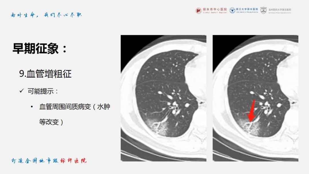 【PPT】新冠肺炎CT早期征象与临床基础及鉴别诊断