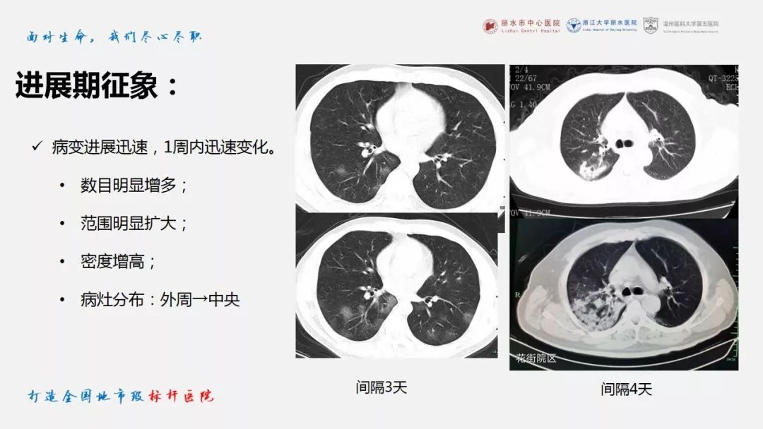 【PPT】新冠肺炎CT早期征象与临床基础及鉴别诊断