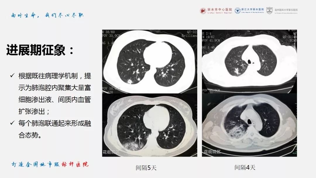 【PPT】新冠肺炎CT早期征象与临床基础及鉴别诊断