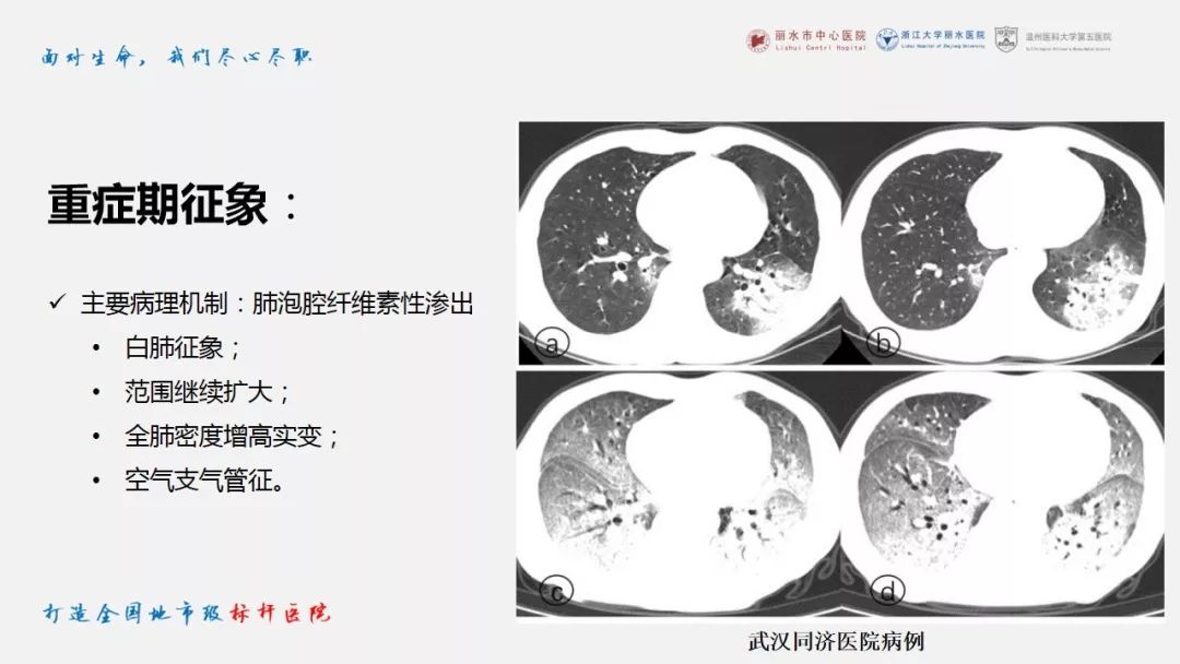 【PPT】新冠肺炎CT早期征象与临床基础及鉴别诊断