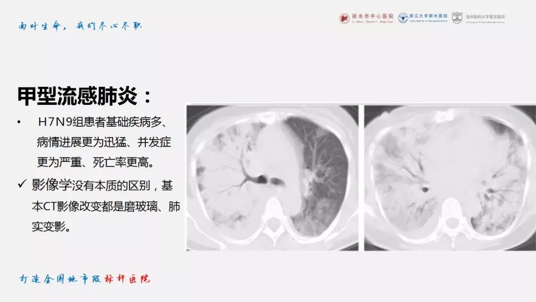 【PPT】新冠肺炎CT早期征象与临床基础及鉴别诊断