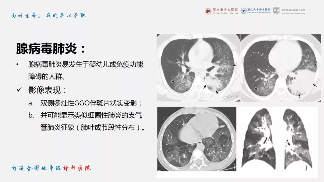【PPT】新冠肺炎CT早期征象与临床基础及鉴别诊断