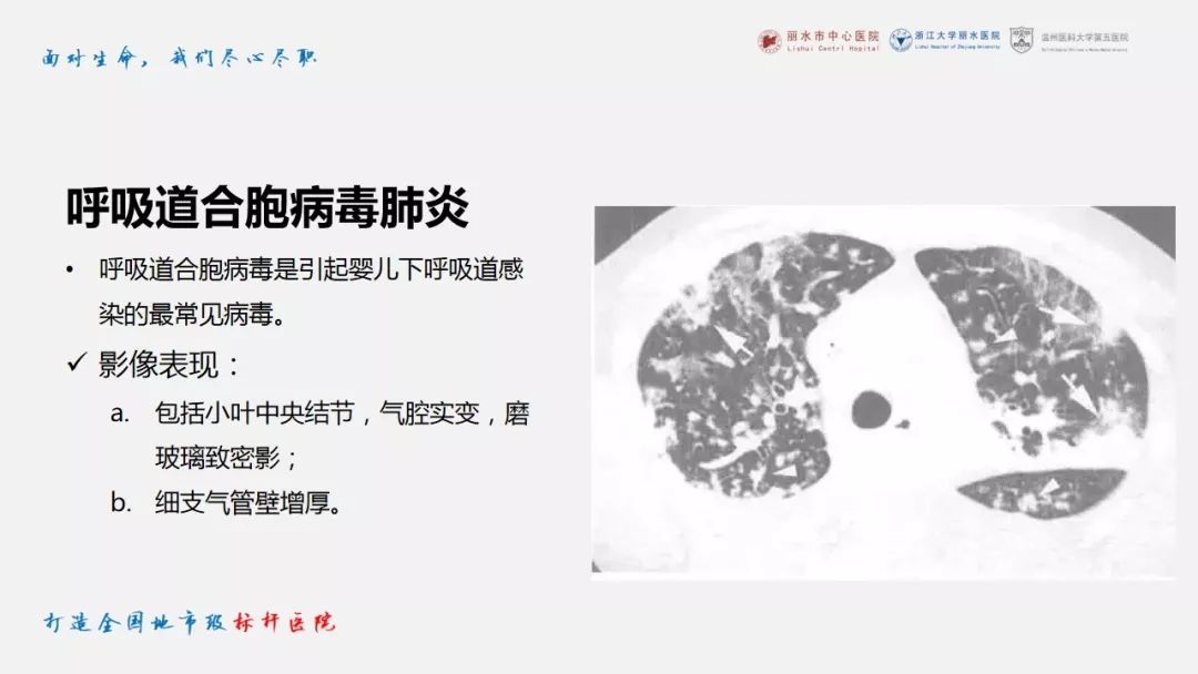 【PPT】新冠肺炎CT早期征象与临床基础及鉴别诊断