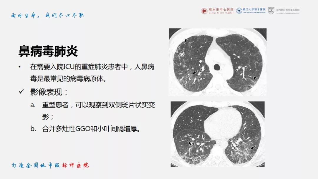 【PPT】新冠肺炎CT早期征象与临床基础及鉴别诊断