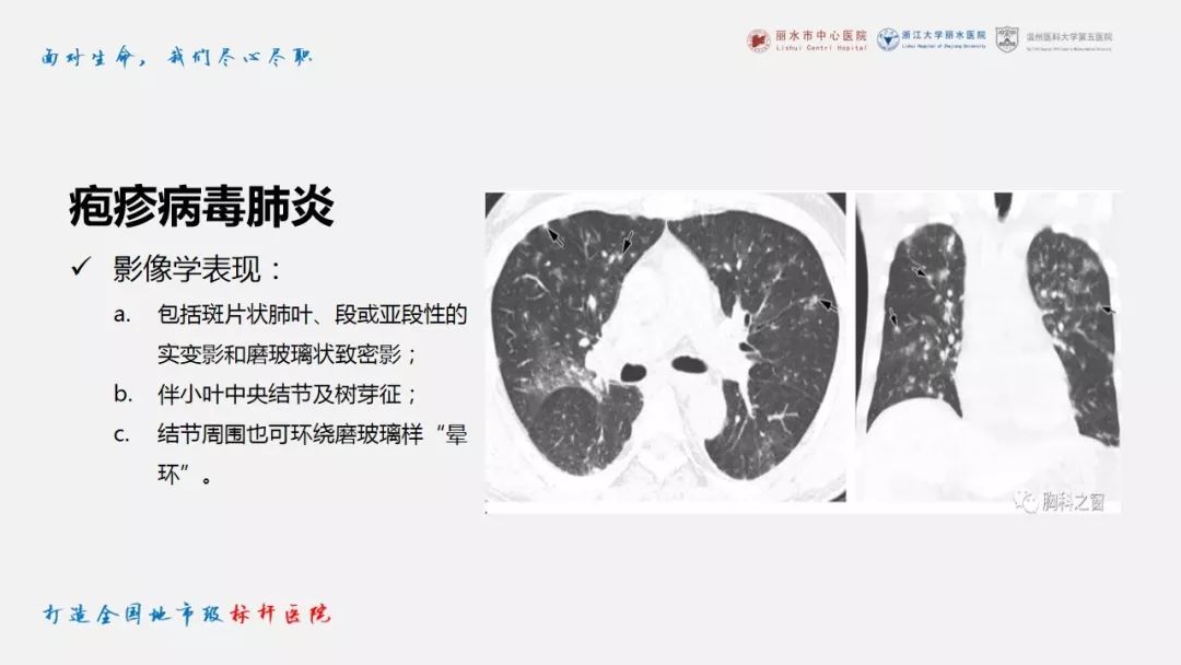 【PPT】新冠肺炎CT早期征象与临床基础及鉴别诊断
