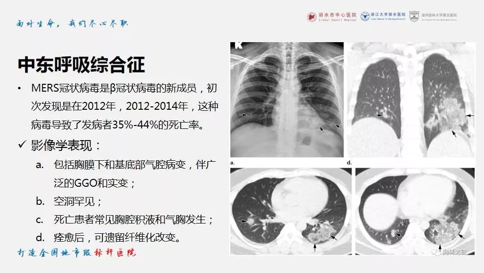【PPT】新冠肺炎CT早期征象与临床基础及鉴别诊断
