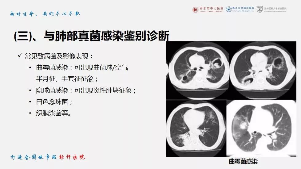 【PPT】新冠肺炎CT早期征象与临床基础及鉴别诊断