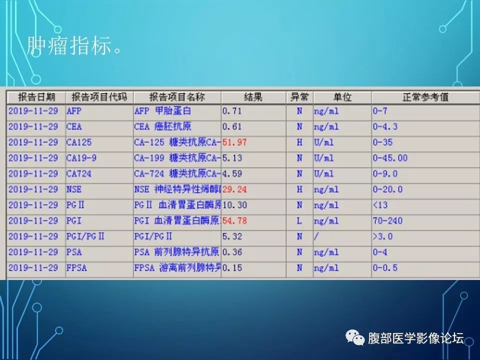 【病例】小肠间质瘤1例CT影像