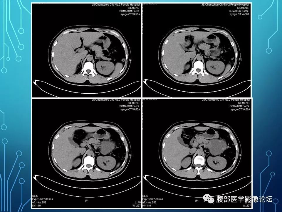 【病例】小肠间质瘤1例CT影像