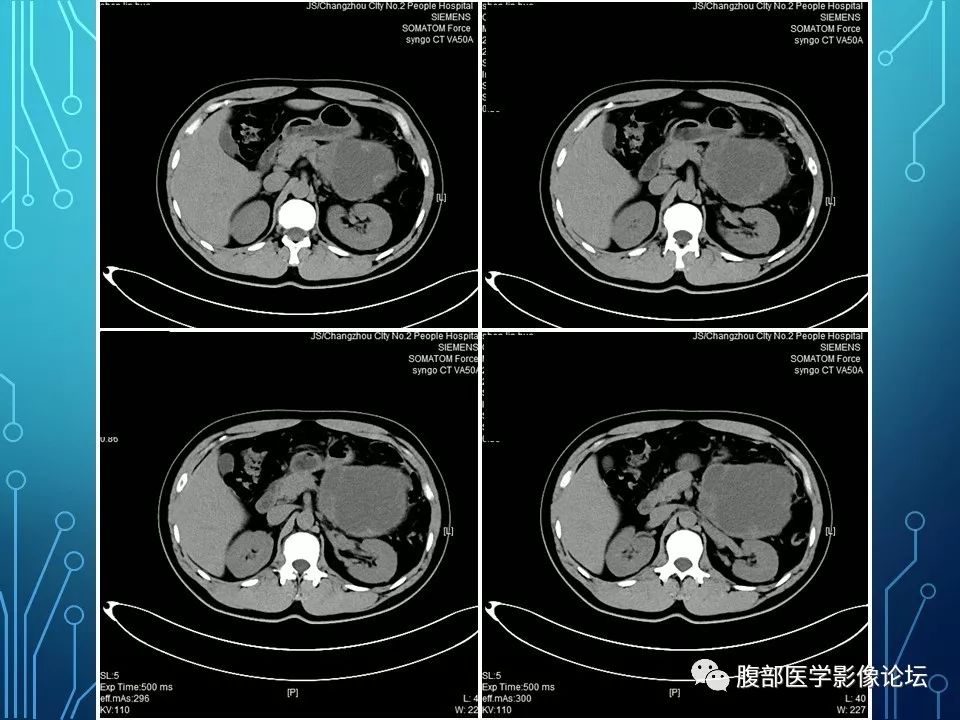 【病例】小肠间质瘤1例CT影像