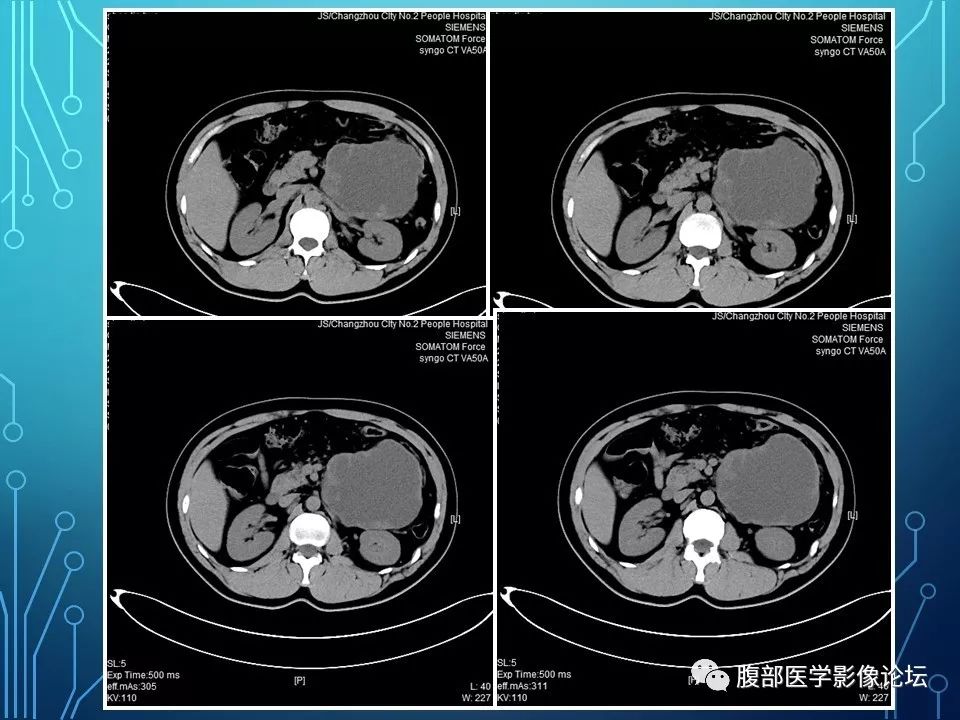 【病例】小肠间质瘤1例CT影像