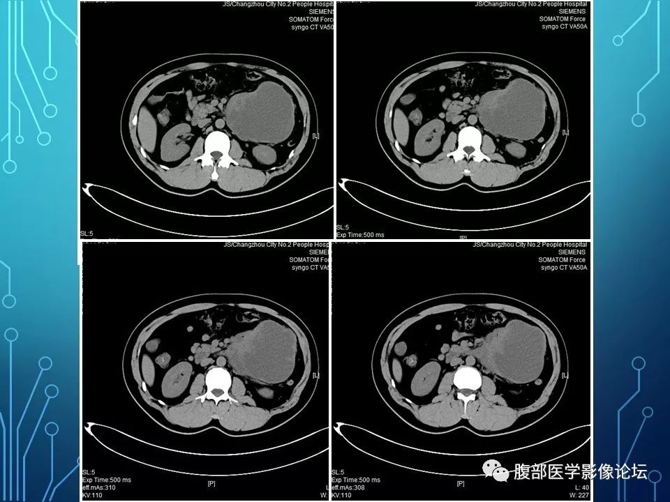 【病例】小肠间质瘤1例CT影像