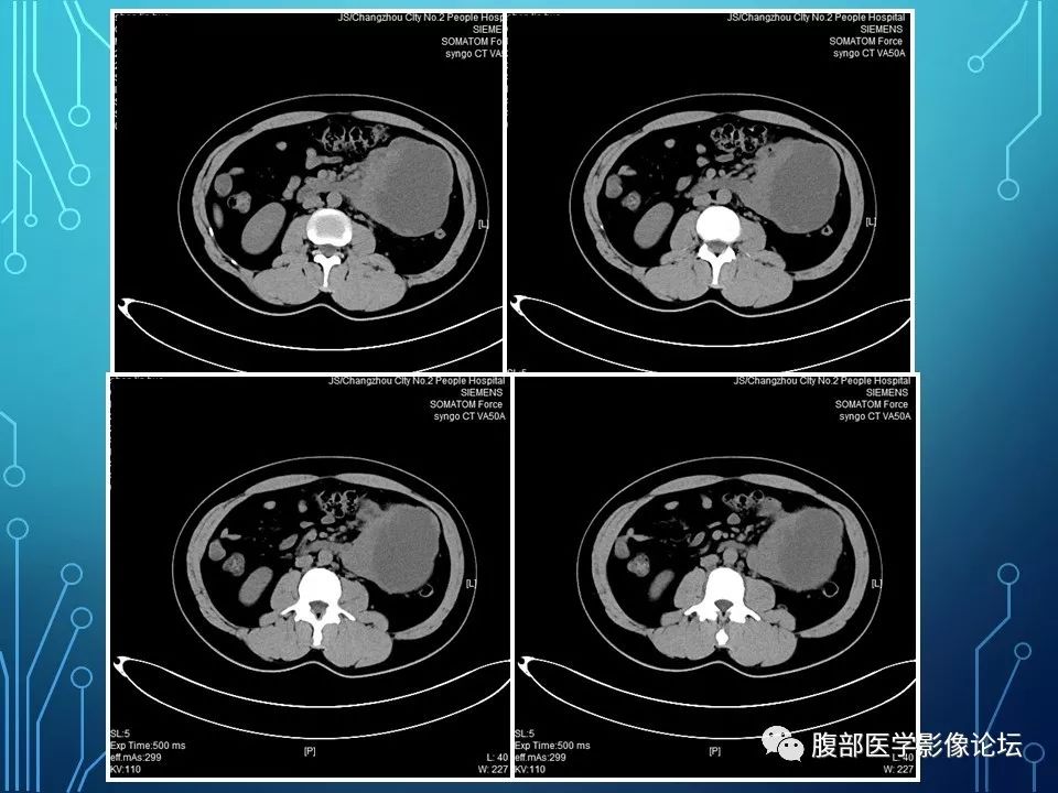【病例】小肠间质瘤1例CT影像