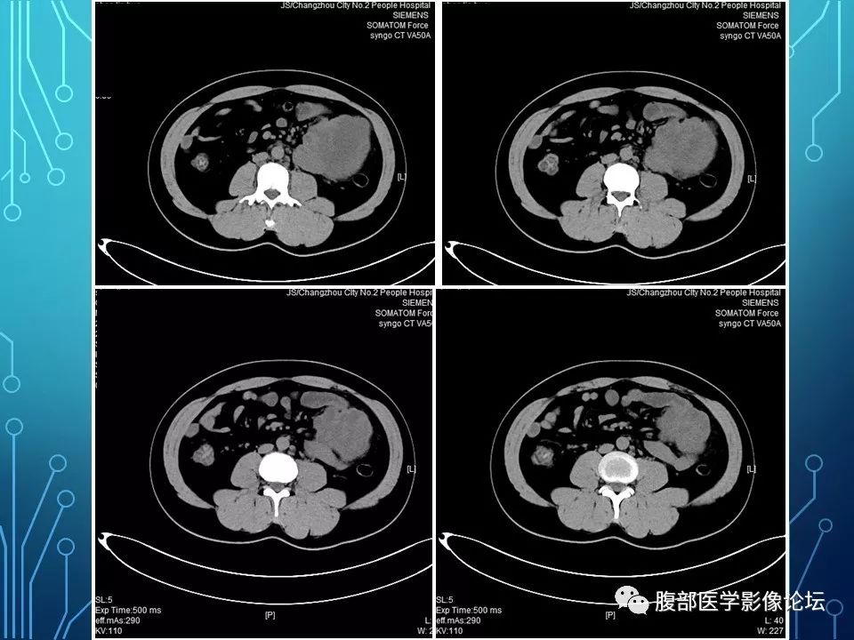 【病例】小肠间质瘤1例CT影像