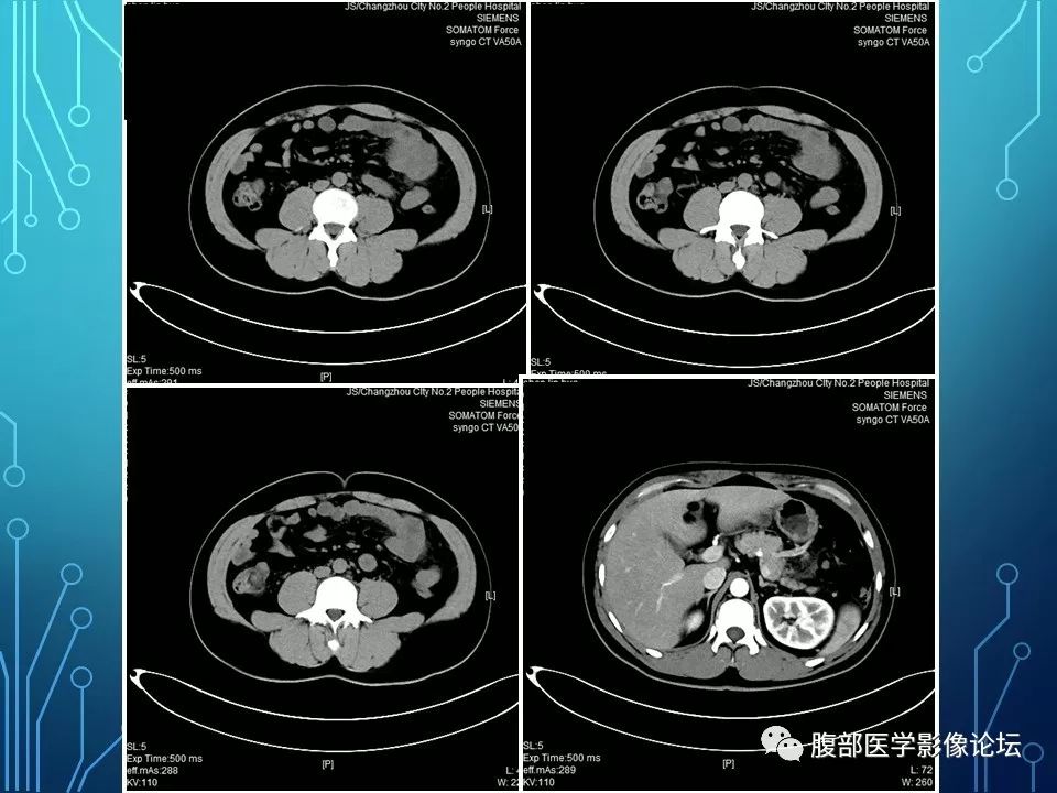【病例】小肠间质瘤1例CT影像