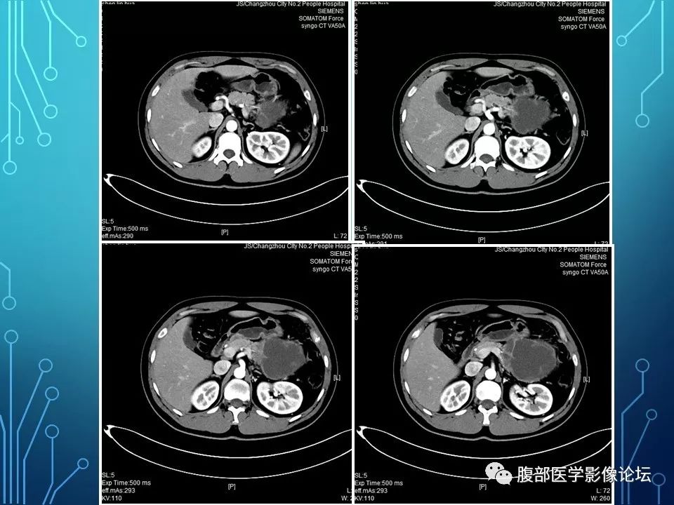 【病例】小肠间质瘤1例CT影像