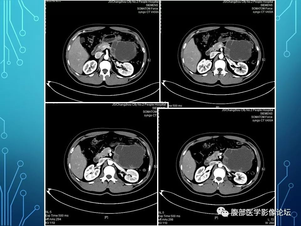 【病例】小肠间质瘤1例CT影像