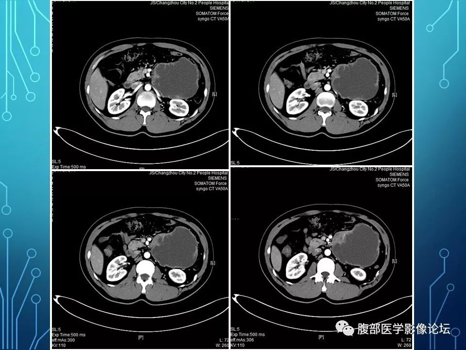 【病例】小肠间质瘤1例CT影像
