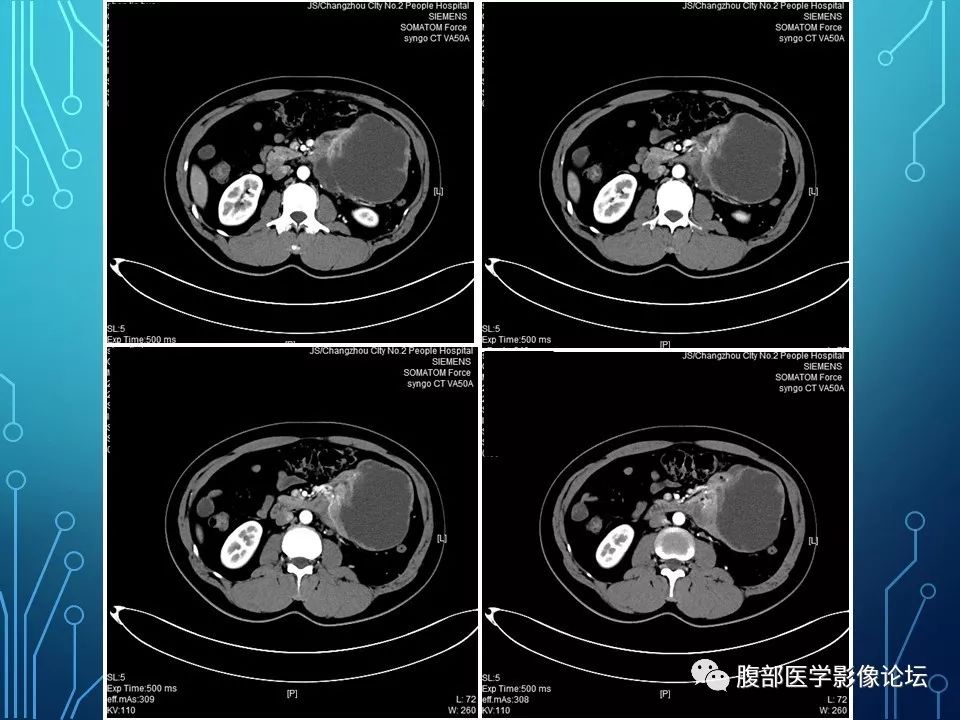 【病例】小肠间质瘤1例CT影像