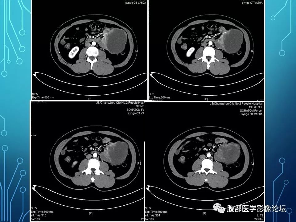【病例】小肠间质瘤1例CT影像