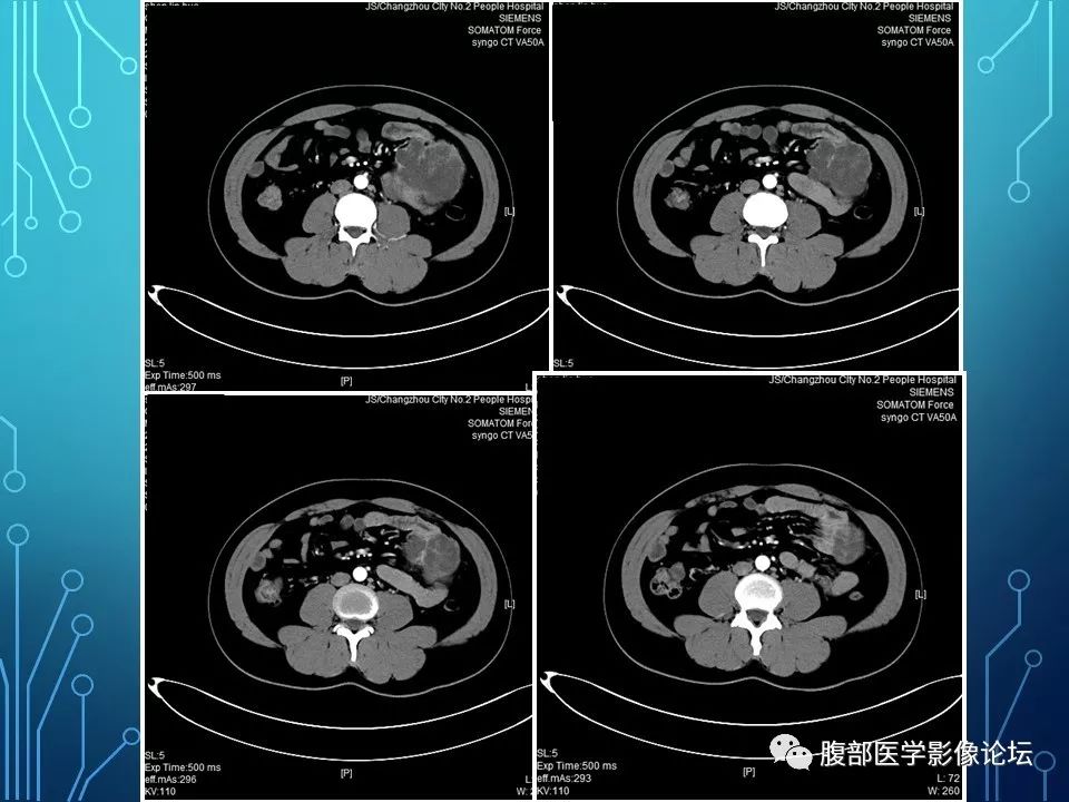 【病例】小肠间质瘤1例CT影像