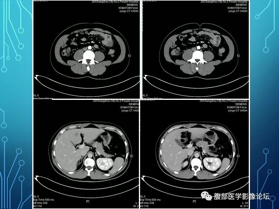 【病例】小肠间质瘤1例CT影像