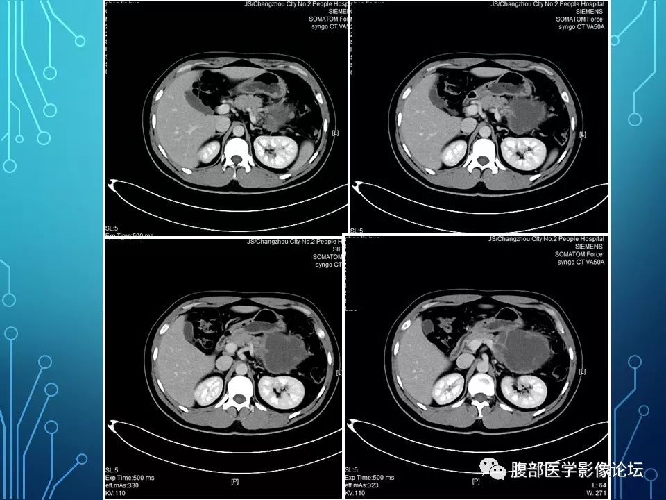 【病例】小肠间质瘤1例CT影像