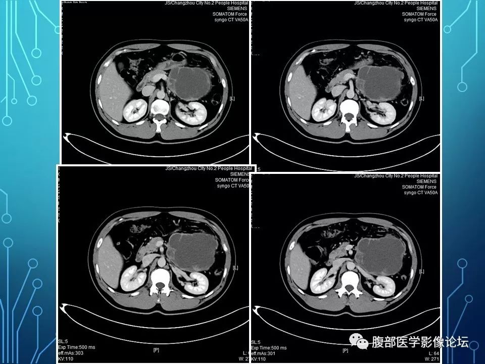 【病例】小肠间质瘤1例CT影像
