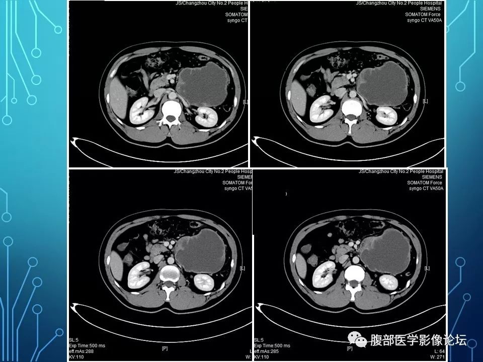 【病例】小肠间质瘤1例CT影像