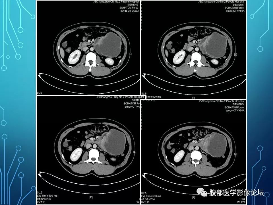 【病例】小肠间质瘤1例CT影像