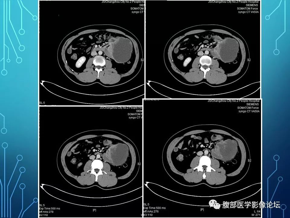 【病例】小肠间质瘤1例CT影像