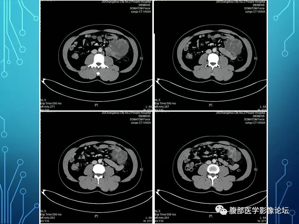 【病例】小肠间质瘤1例CT影像