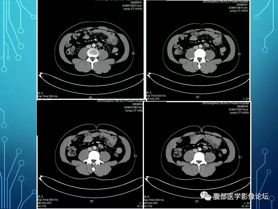 【病例】小肠间质瘤1例CT影像