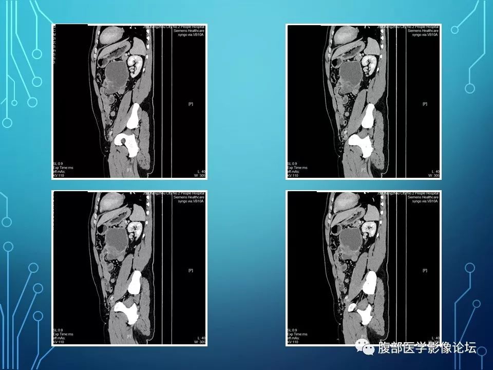 【病例】小肠间质瘤1例CT影像