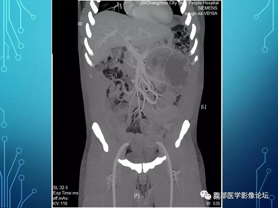 【病例】小肠间质瘤1例CT影像