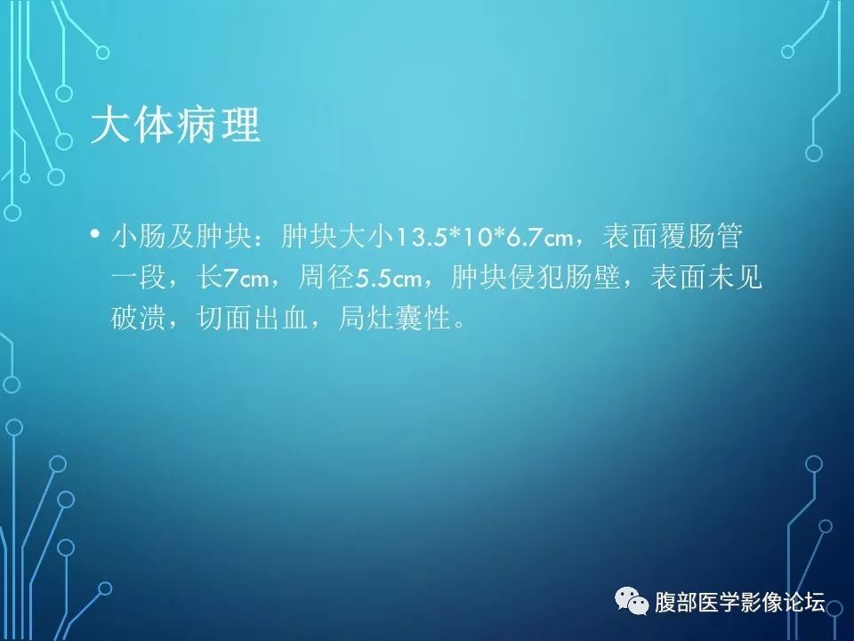 【病例】小肠间质瘤1例CT影像