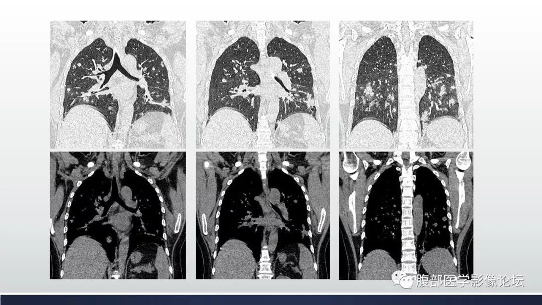 【病例】胰腺、肺结节病1例CT及MR影像