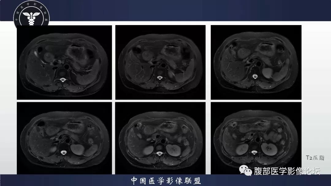 【病例】胰腺、肺结节病1例CT及MR影像
