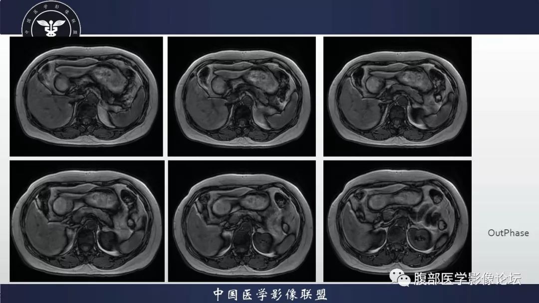 【病例】胰腺、肺结节病1例CT及MR影像