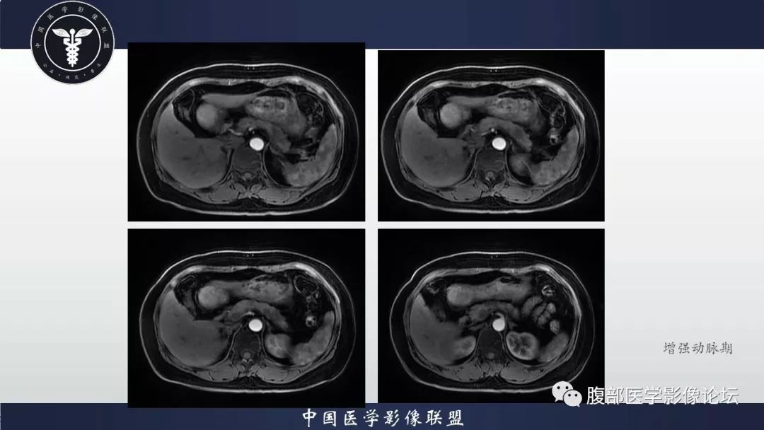 【病例】胰腺、肺结节病1例CT及MR影像