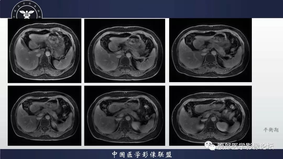【病例】胰腺、肺结节病1例CT及MR影像