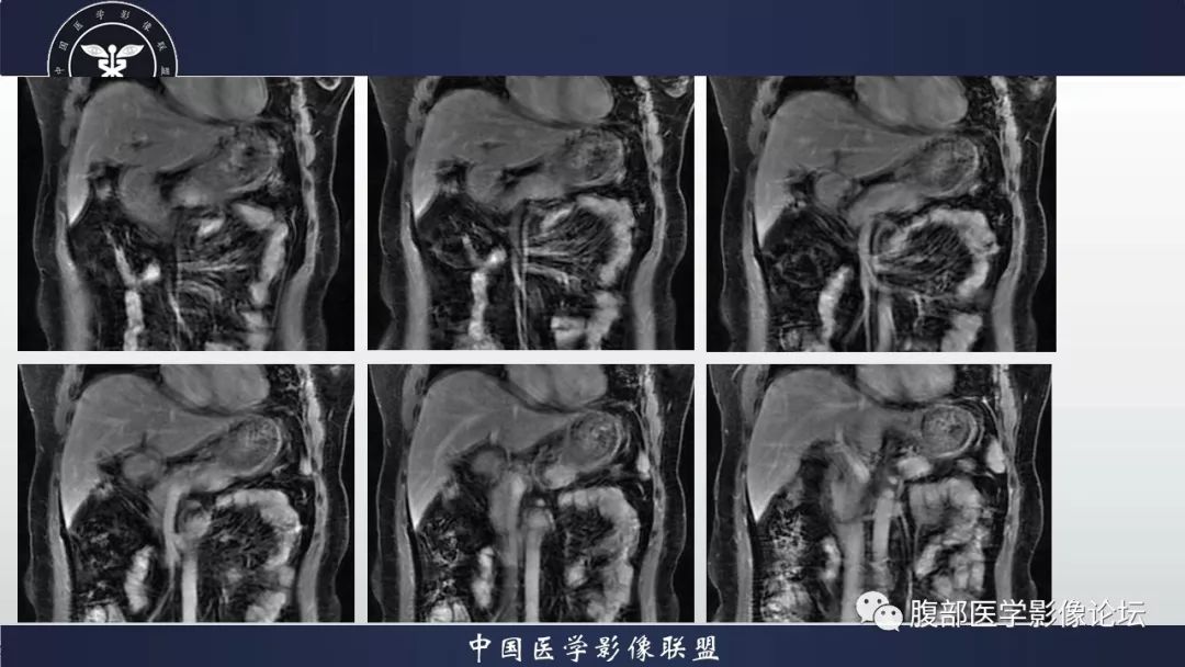 【病例】胰腺、肺结节病1例CT及MR影像
