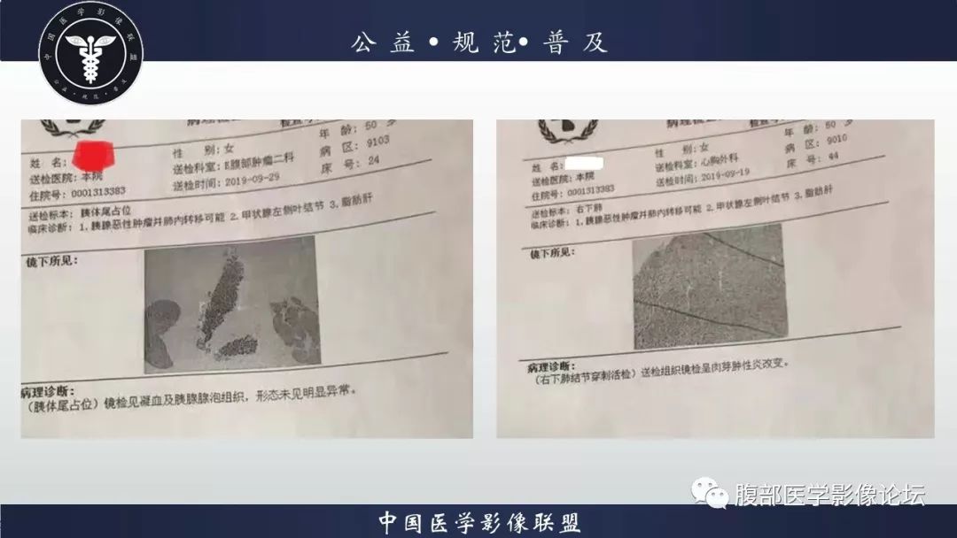 【病例】胰腺、肺结节病1例CT及MR影像