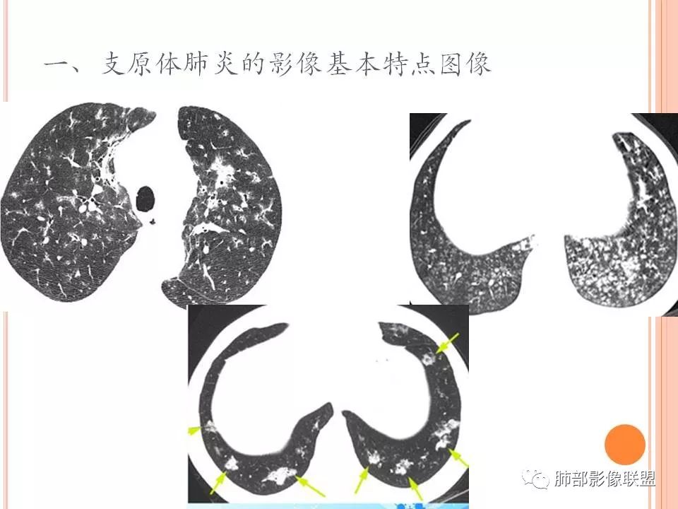 【PPT】支原体肺炎影像分析 【PPT】支原体肺炎影像分析