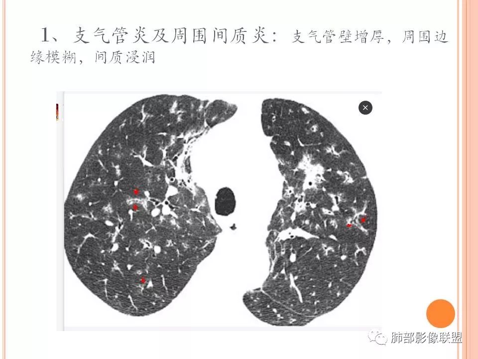 【PPT】支原体肺炎影像分析 【PPT】支原体肺炎影像分析