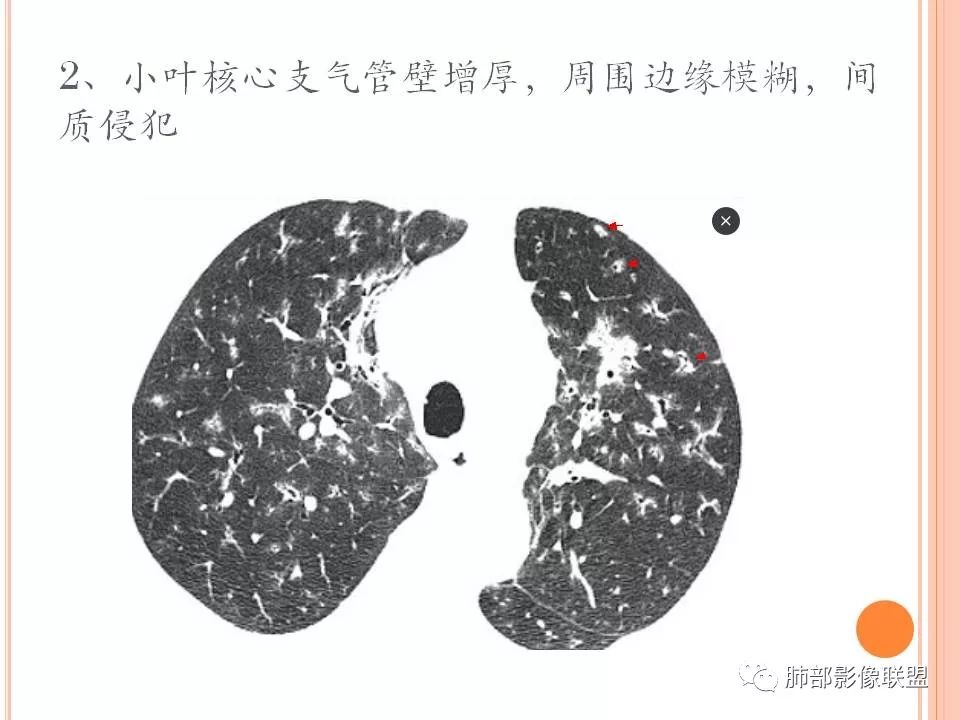 【PPT】支原体肺炎影像分析 【PPT】支原体肺炎影像分析