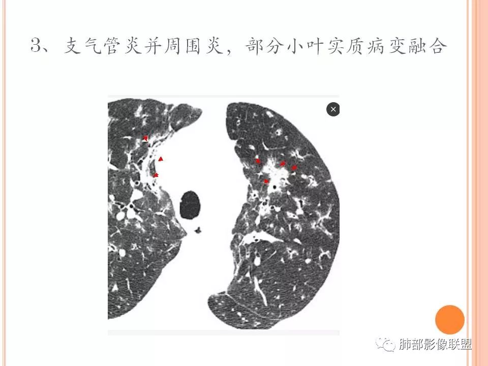 【PPT】支原体肺炎影像分析 【PPT】支原体肺炎影像分析